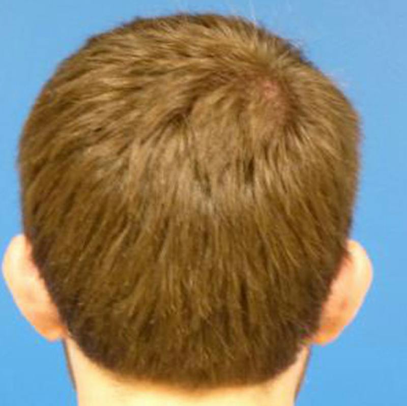 Otoplasty Before & After Gallery - Patient 375566 - Image 1