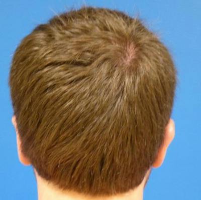 Otoplasty Before & After Gallery - Patient 375566 - Image 2
