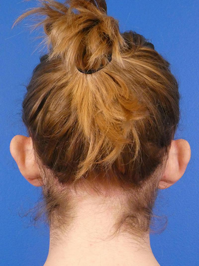 Otoplasty Before & After Gallery - Patient 366849 - Image 3