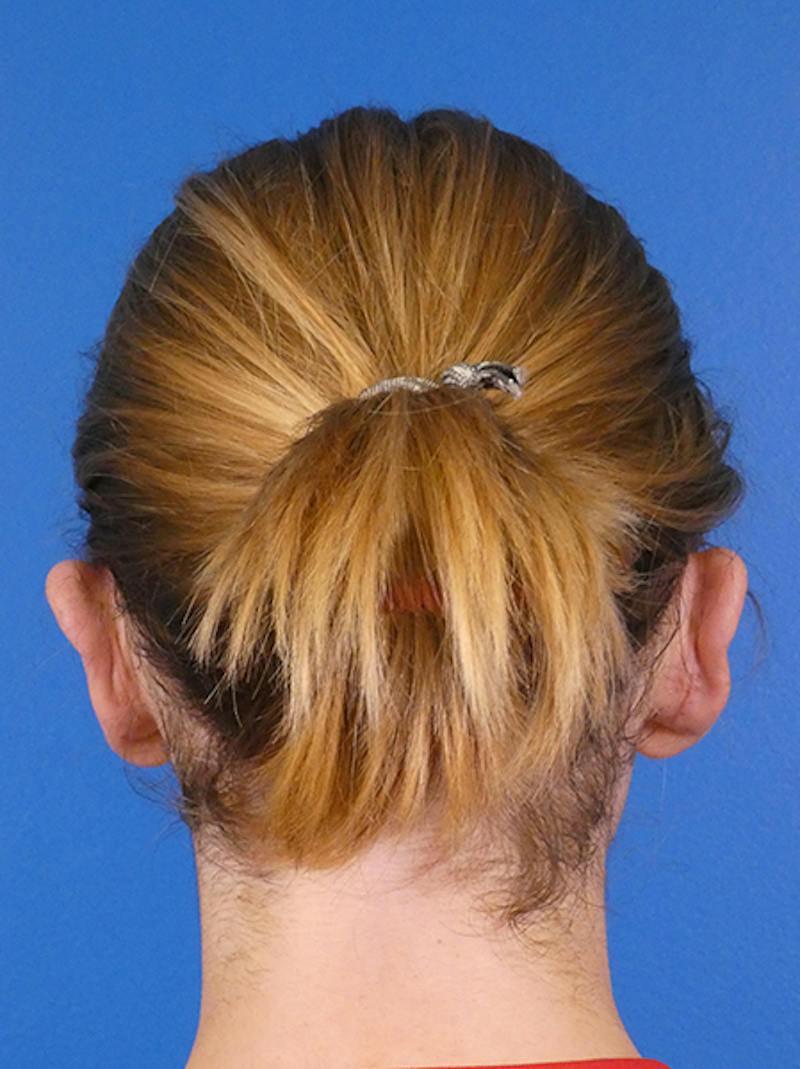Otoplasty Before & After Gallery - Patient 366849 - Image 4
