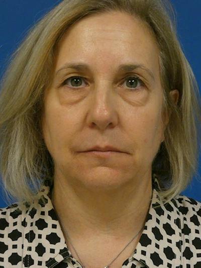 Rhinoplasty Before & After Gallery - Patient 405667 - Image 1