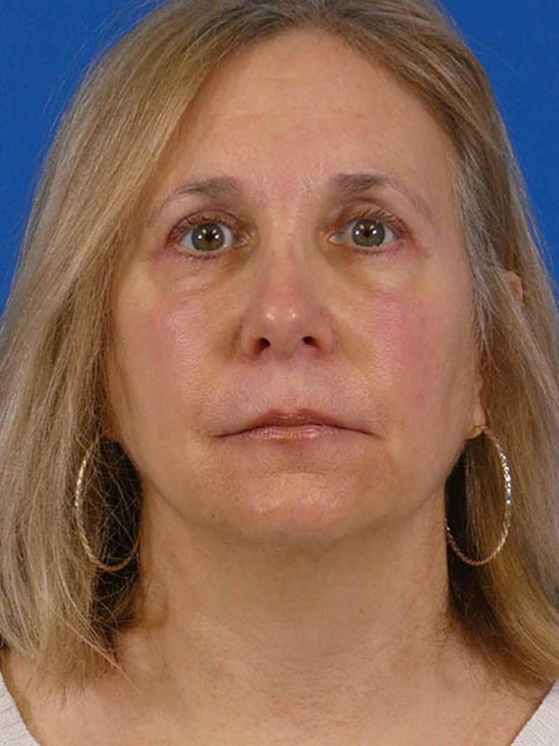 Rhinoplasty Before & After Gallery - Patient 405667 - Image 2