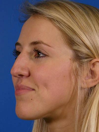 Rhinoplasty Before & After Gallery - Patient 144763 - Image 1