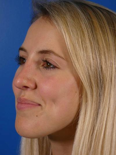 Rhinoplasty Before & After Gallery - Patient 144763 - Image 2