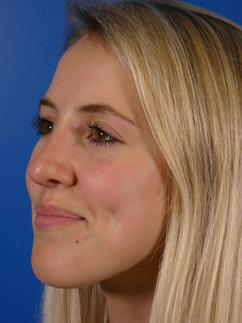 Rhinoplasty Before & After Gallery - Patient 144763 - Image 2