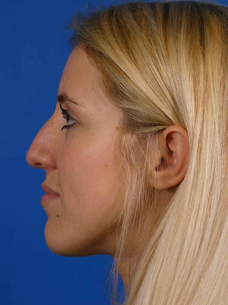 Rhinoplasty Before & After Gallery - Patient 144763 - Image 5