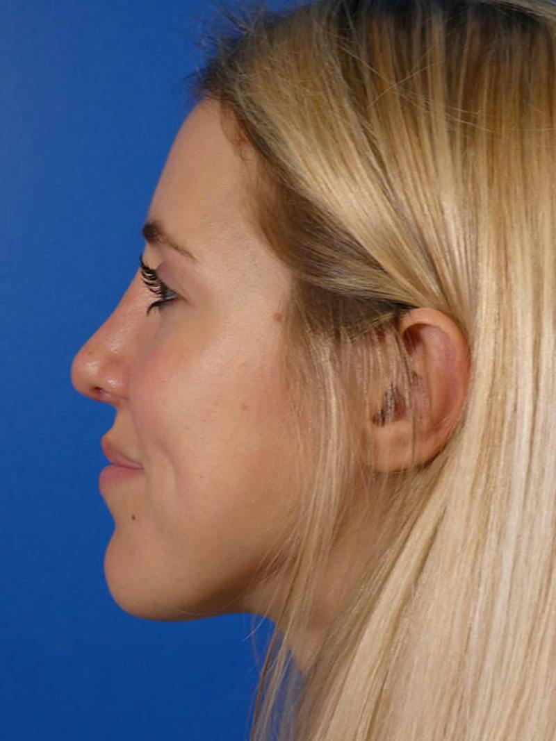 Rhinoplasty Before & After Gallery - Patient 144763 - Image 6