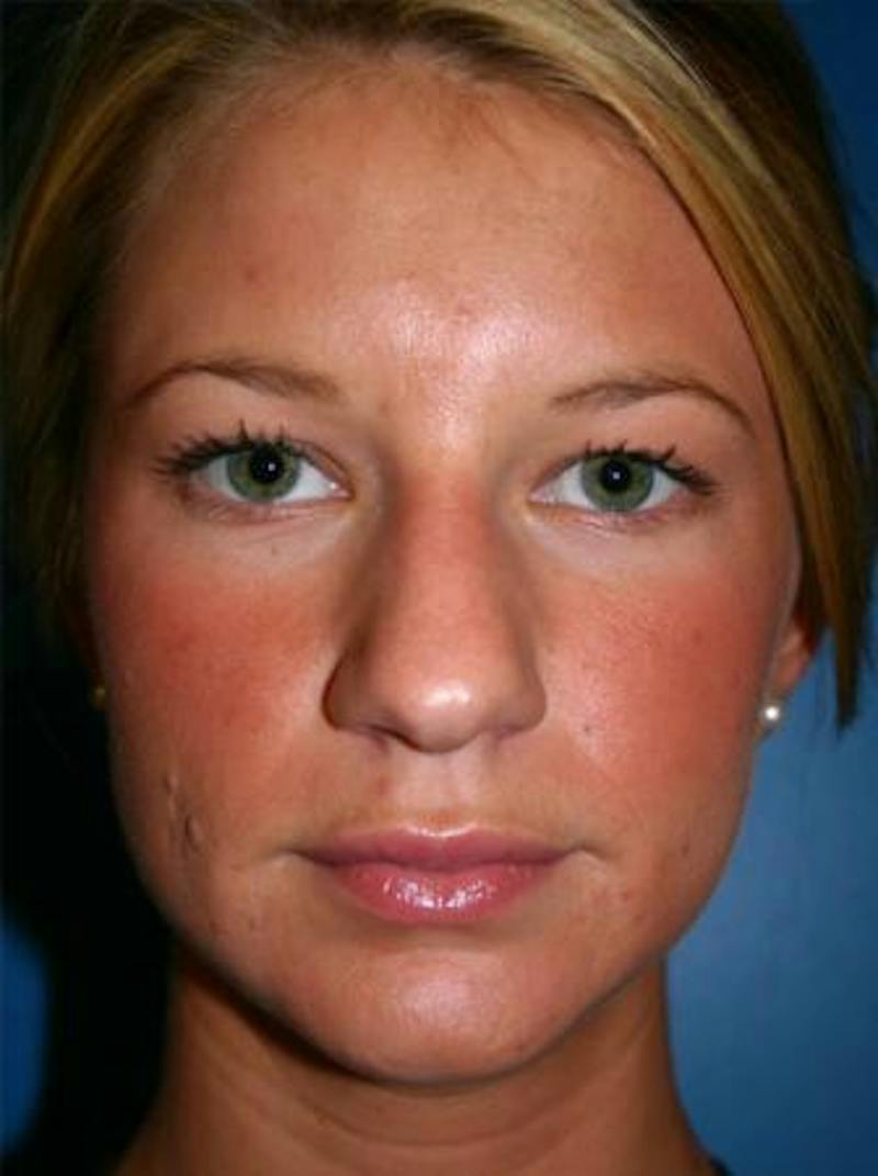 Rhinoplasty Before & After Gallery - Patient 333653 - Image 1