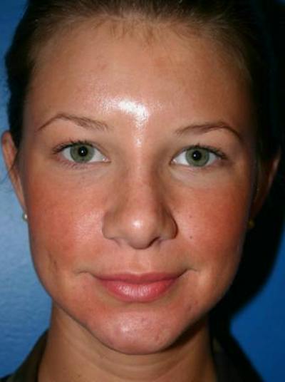 Rhinoplasty Before & After Gallery - Patient 333653 - Image 2