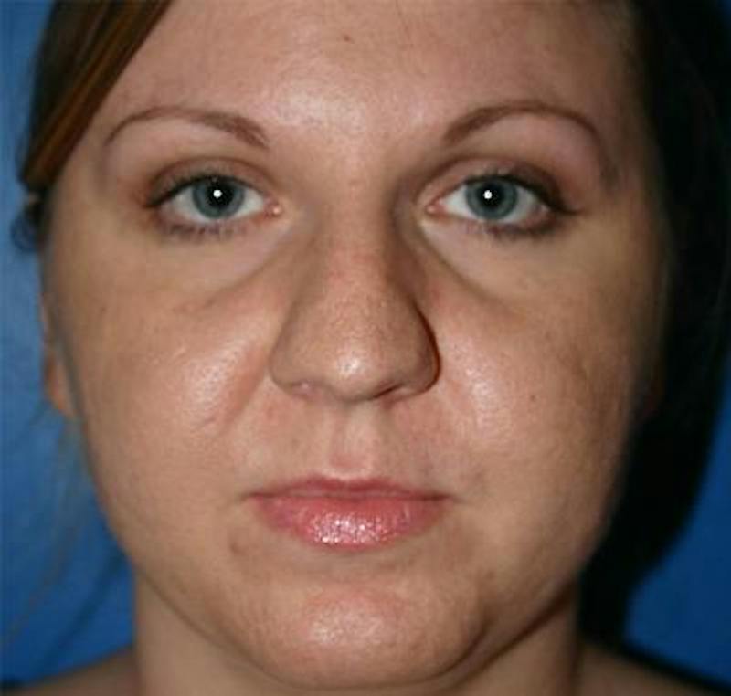 Rhinoplasty Before & After Gallery - Patient 872329 - Image 1