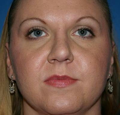 Rhinoplasty Before & After Gallery - Patient 872329 - Image 2