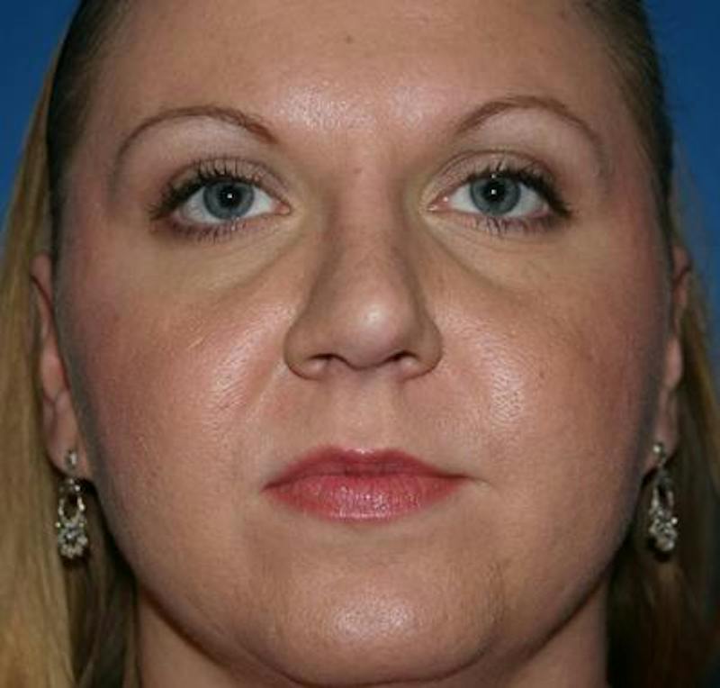Rhinoplasty Before & After Gallery - Patient 872329 - Image 2