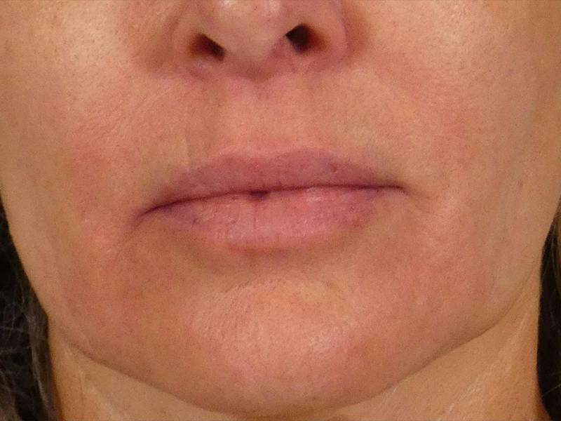 Lip Lift Before & After Gallery - Patient 350325 - Image 1