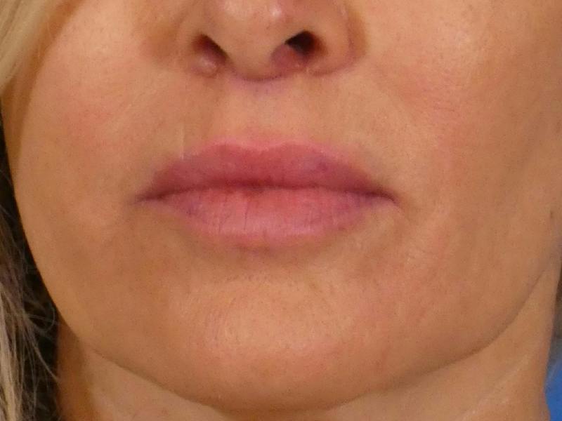 Lip Lift Before & After Gallery - Patient 350325 - Image 2