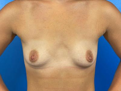 Breast Augmentation Before & After Gallery - Patient 393342 - Image 1