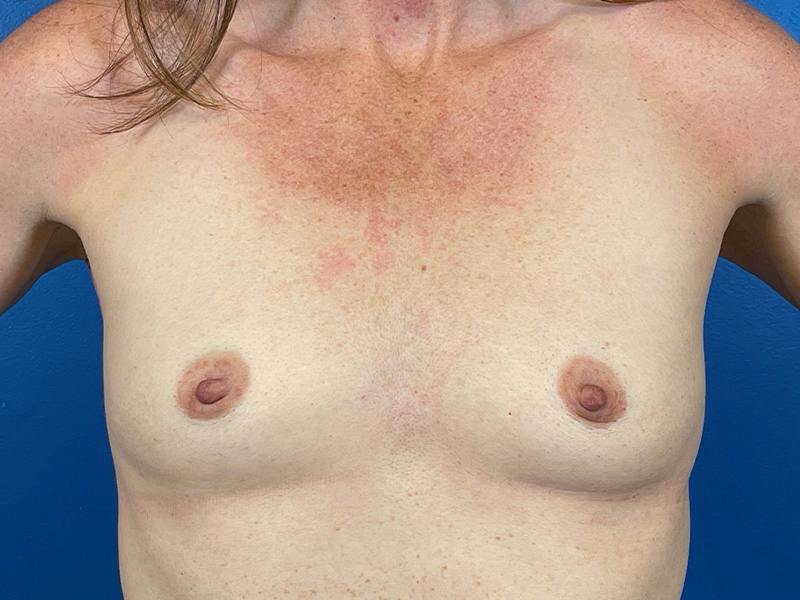 Breast Augmentation Before & After Gallery - Patient 399017 - Image 1