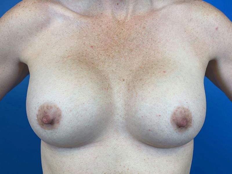 Breast Augmentation Before & After Gallery - Patient 399017 - Image 2