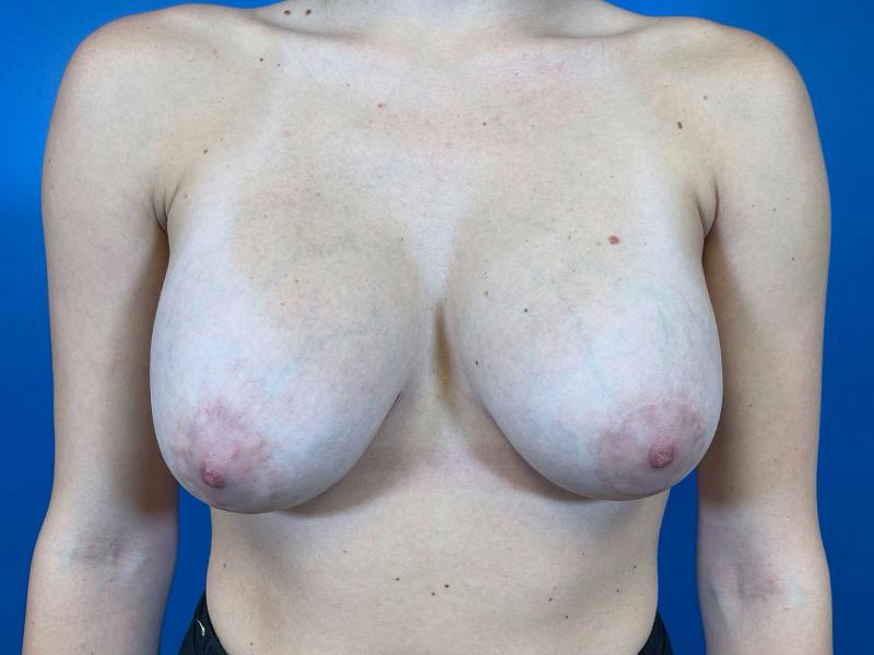 Breast Augmentation Before & After Gallery - Patient 383081 - Image 2