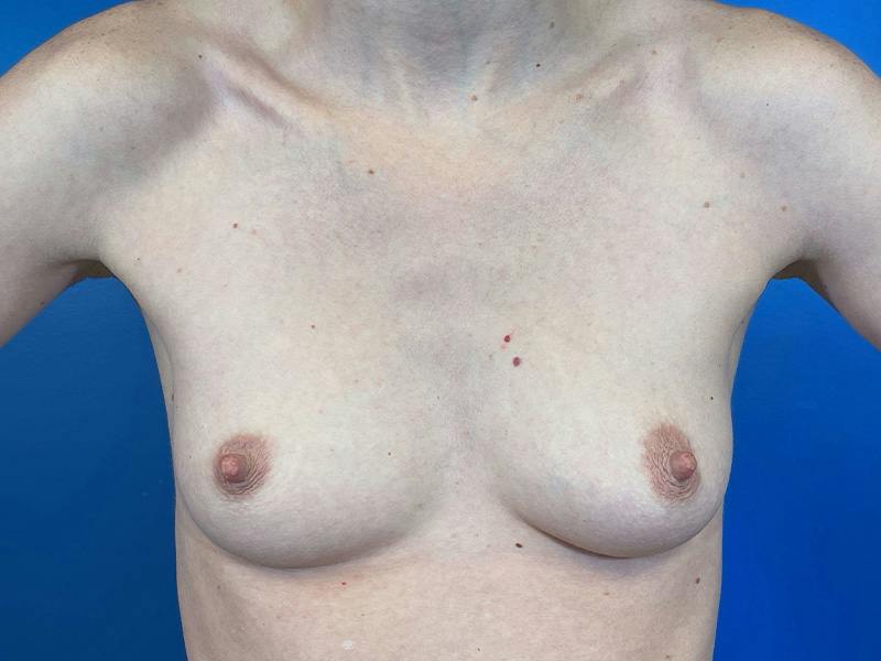 Breast Augmentation Before & After Gallery - Patient 297301 - Image 1