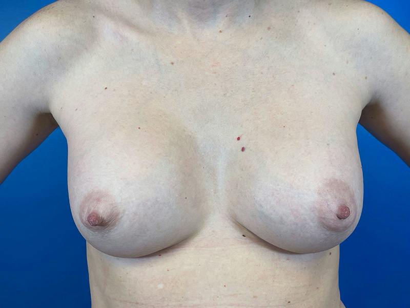 Breast Augmentation Before & After Gallery - Patient 297301 - Image 2