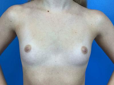 Breast Augmentation Before & After Gallery - Patient 141861 - Image 1