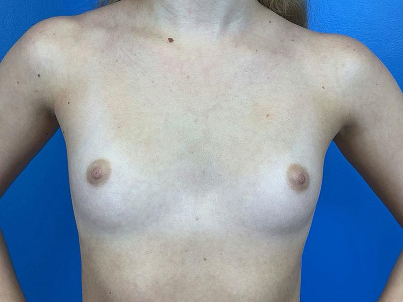 Breast Augmentation Before & After Gallery - Patient 141861 - Image 1