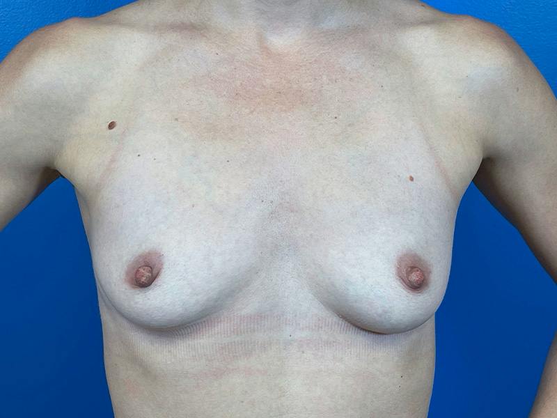 Breast Augmentation Before & After Gallery - Patient 327072 - Image 1