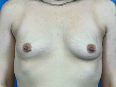 Breast Augmentation Before & After Gallery - Patient 144915 - Image 1