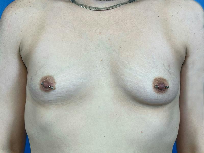 Breast Augmentation Before & After Gallery - Patient 144915 - Image 1