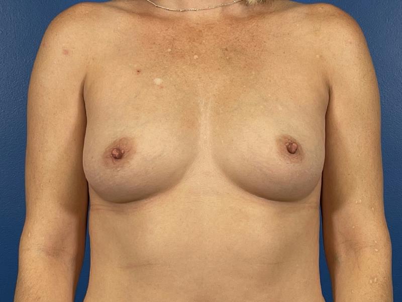 Breast Augmentation Before & After Gallery - Patient 226396 - Image 1