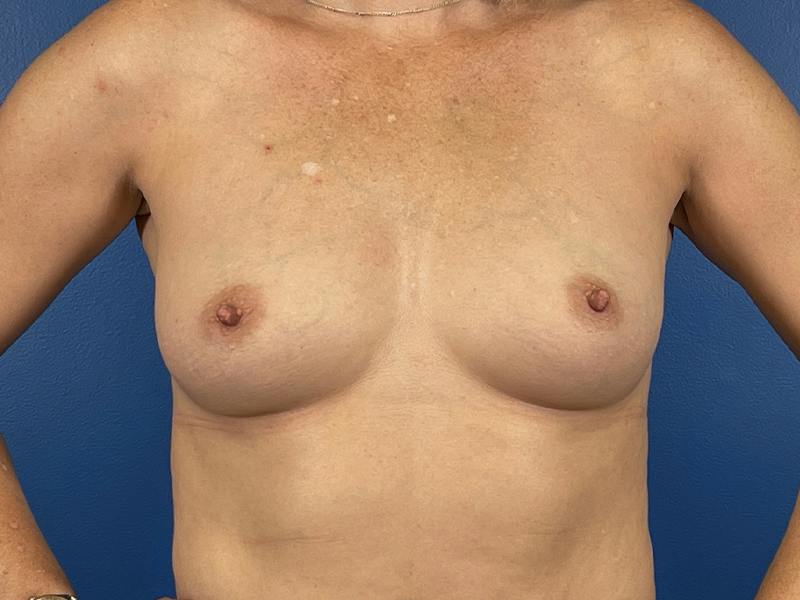 Breast Augmentation Before & After Gallery - Patient 226396 - Image 3