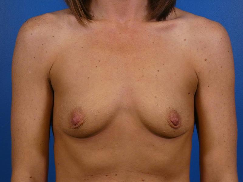 Breast Augmentation Before & After Gallery - Patient 217310 - Image 1