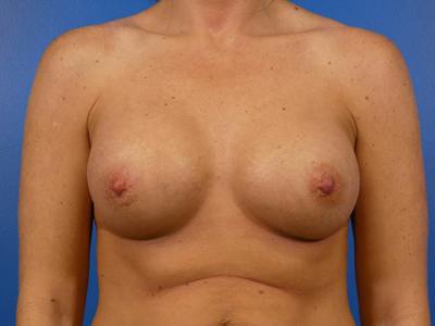 Breast Augmentation Before & After Gallery - Patient 217310 - Image 2