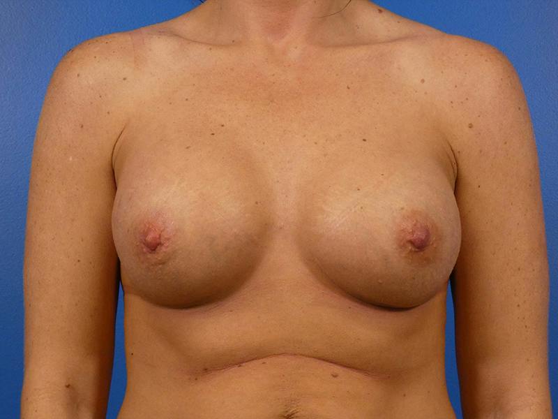 Breast Augmentation Before & After Gallery - Patient 217310 - Image 2