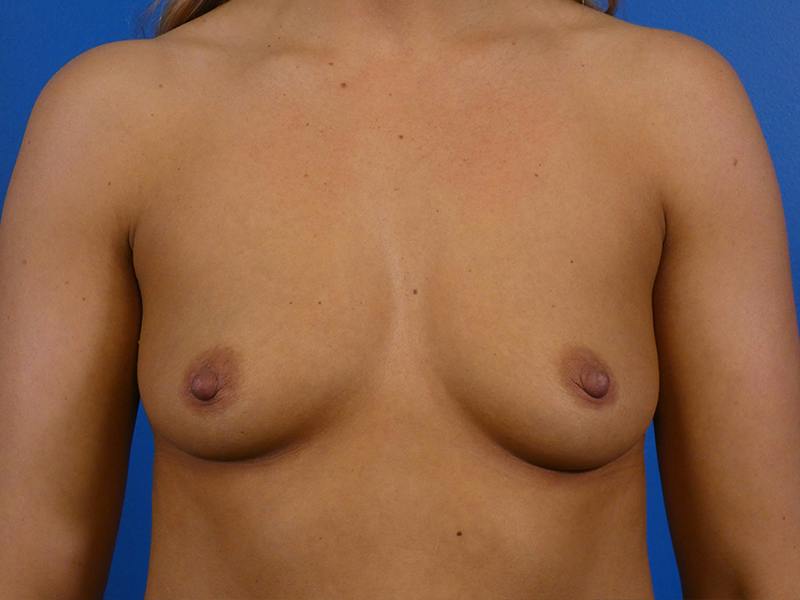 Breast Augmentation Before & After Gallery - Patient 829184 - Image 1