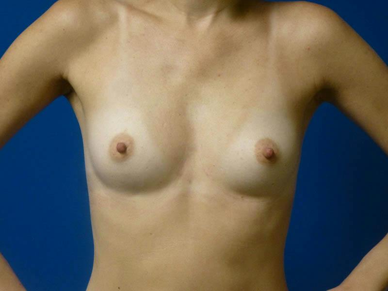 Breast Augmentation Before & After Gallery - Patient 294568 - Image 1