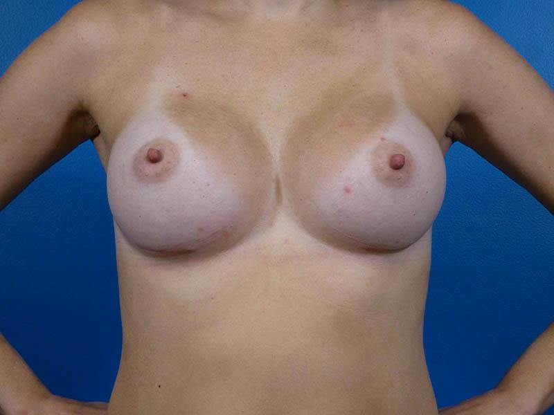 Breast Augmentation Before & After Gallery - Patient 294568 - Image 2