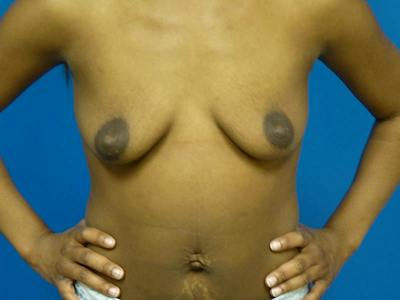 Breast Augmentation Before & After Gallery - Patient 998544 - Image 1