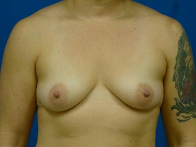 Breast Augmentation Before & After Gallery - Patient 354622 - Image 1