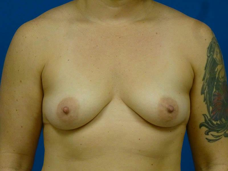 Breast Augmentation Before & After Gallery - Patient 354622 - Image 1