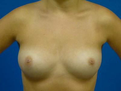 Breast Augmentation Before & After Gallery - Patient 289364 - Image 1