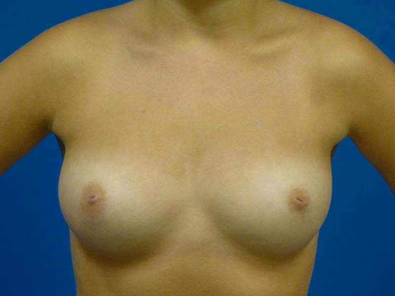 Breast Augmentation Before & After Gallery - Patient 289364 - Image 1