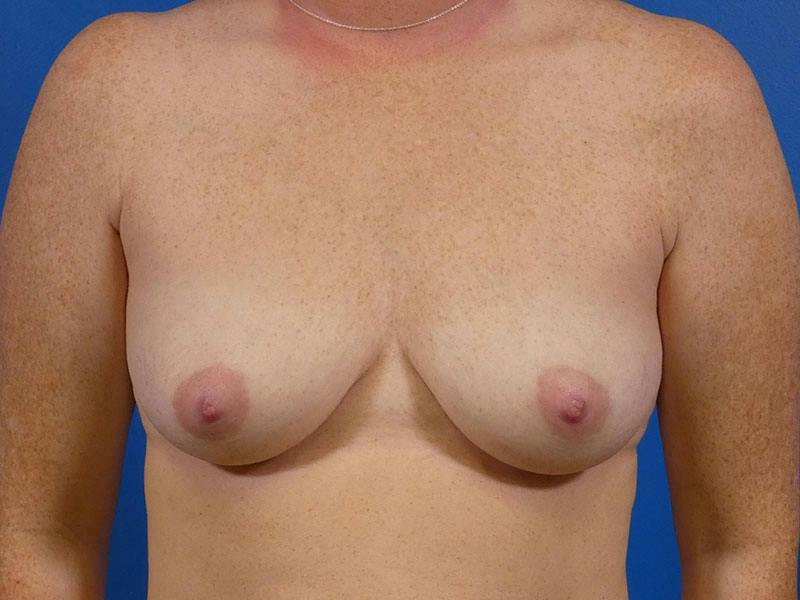 Breast Augmentation Before & After Gallery - Patient 722928 - Image 1