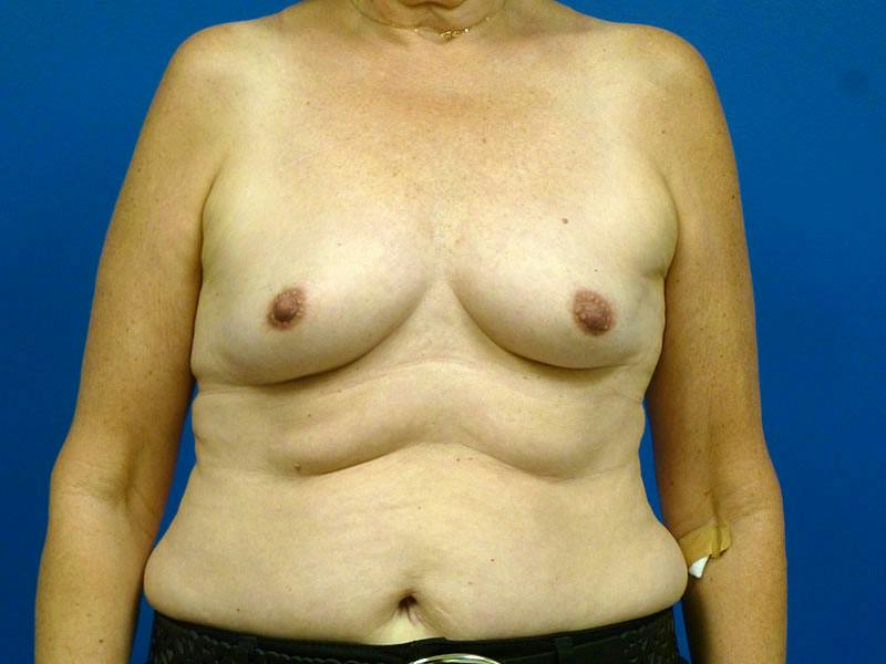 Breast Augmentation Before & After Gallery - Patient 135253 - Image 1