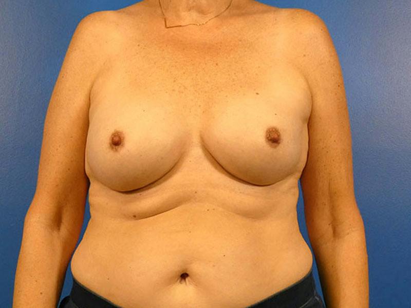 Breast Augmentation Before & After Gallery - Patient 135253 - Image 2