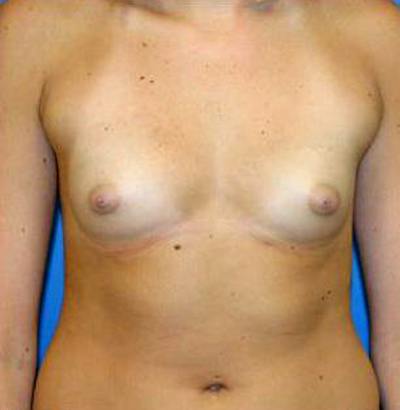 Breast Augmentation Before & After Gallery - Patient 261060 - Image 1