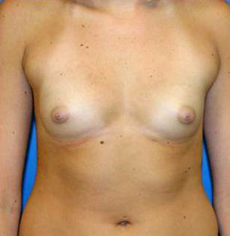 Breast Augmentation Before & After Gallery - Patient 261060 - Image 1
