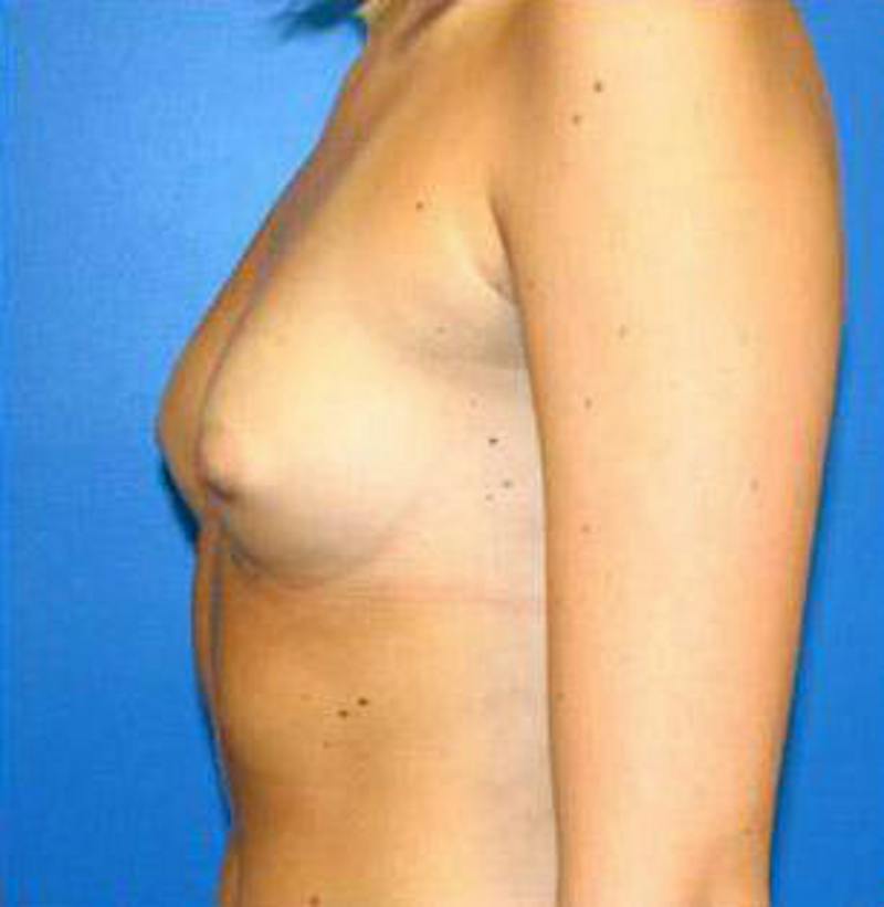 Breast Augmentation Before & After Gallery - Patient 261060 - Image 3