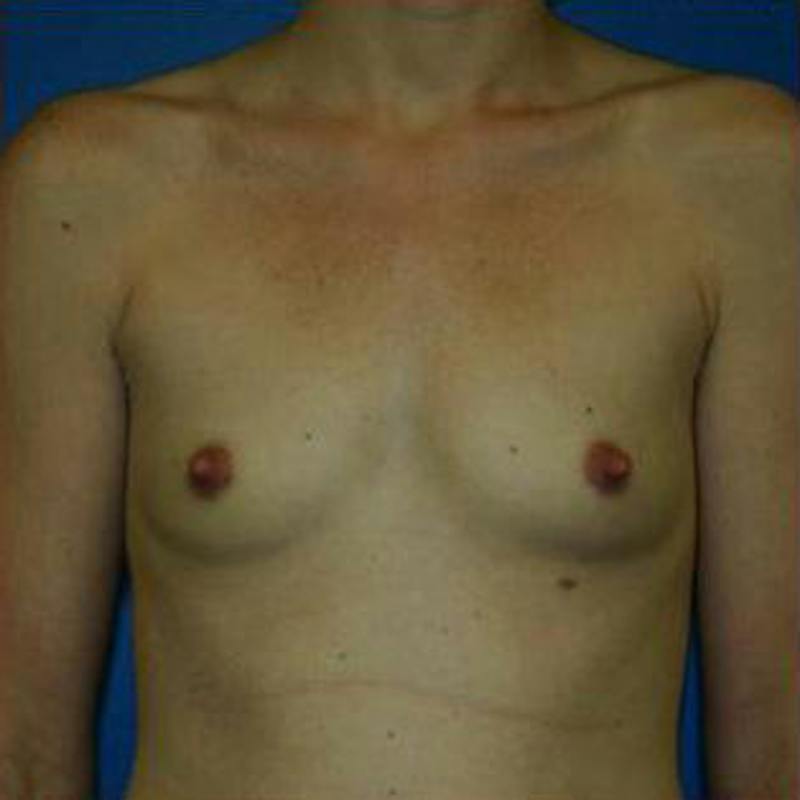 Breast Augmentation Before & After Gallery - Patient 351514 - Image 1