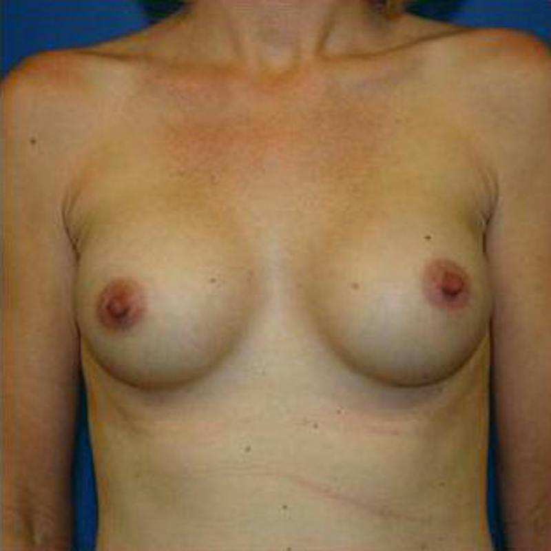 Breast Augmentation Before & After Gallery - Patient 351514 - Image 2